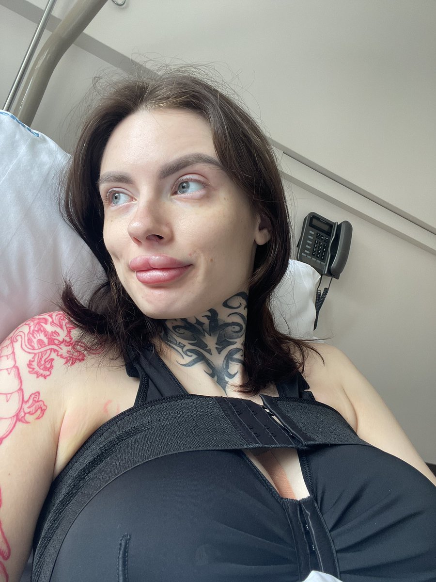 JennyQuenn3's tweet photo. I got boobs surgery, I hope in a next month I will be ready to work again:3 https://t.co/Bw2gdkjmwz