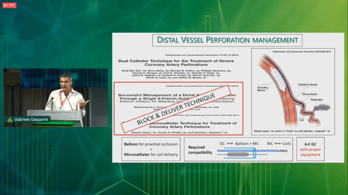 Aaysha Cader (@aayshacader) on Twitter photo Block and Deliver technique for distal vessel perfs:
The BAD technique is a GOOD technique! 😂 Well-said <a href="/azeemlatib/">Azeem Latib</a> !!
#JIM2022 @jim_vascular <a href="/SticchiAlex/">Alessandro Sticchi</a> <a href="/aayshacader/">Aaysha Cader</a> <a href="/ABeneduceMD/">Alessandro Beneduce</a> <a href="/DrArifK/">Arif Khokhar</a> <a href="/CurioJonathan/">Jonathan Curio</a> <a href="/valeriaparadies/">Valeria Paradies</a> <a href="/OrtegaPaz/">Paz Ortega Aparicio</a> <a href="/mirvatalasnag/">MIЯVΛƬ #IC ༄ 。°</a> @NicolaRyan1 <a href="/ShrillaB/">Dr Shrilla Banerjee MD FRCP 💙</a> Block and Deliver technique for distal vessel perfs:
The BAD technique is a GOOD technique! 😂 Well-said <a href="/azeemlatib/">Azeem Latib</a> !!
#JIM2022 @jim_vascular <a href="/SticchiAlex/">Alessandro Sticchi</a> <a href="/aayshacader/">Aaysha Cader</a> <a href="/ABeneduceMD/">Alessandro Beneduce</a> <a href="/DrArifK/">Arif Khokhar</a> <a href="/CurioJonathan/">Jonathan Curio</a> <a href="/valeriaparadies/">Valeria Paradies</a> <a href="/OrtegaPaz/">Paz Ortega Aparicio</a> <a href="/mirvatalasnag/">MIЯVΛƬ #IC ༄ 。°</a> @NicolaRyan1 <a href="/ShrillaB/">Dr Shrilla Banerjee MD FRCP 💙</a>
