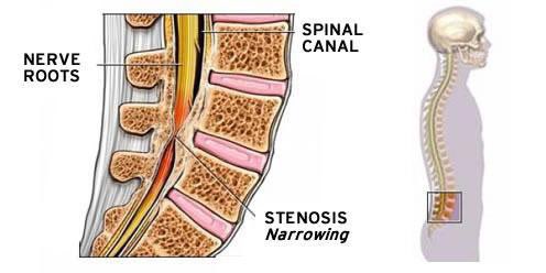 AdamMeakins's tweet photo. This is a very good expert consensus on the management of Lumbar Stenosis using a patient phenotype, phased progressive stepped approach! 

It should help reduce variation in treatment… but only if clinicians read and follow it!  https://t.co/0MdMyZvJBt https://t.co/lmtK1ZdQ13