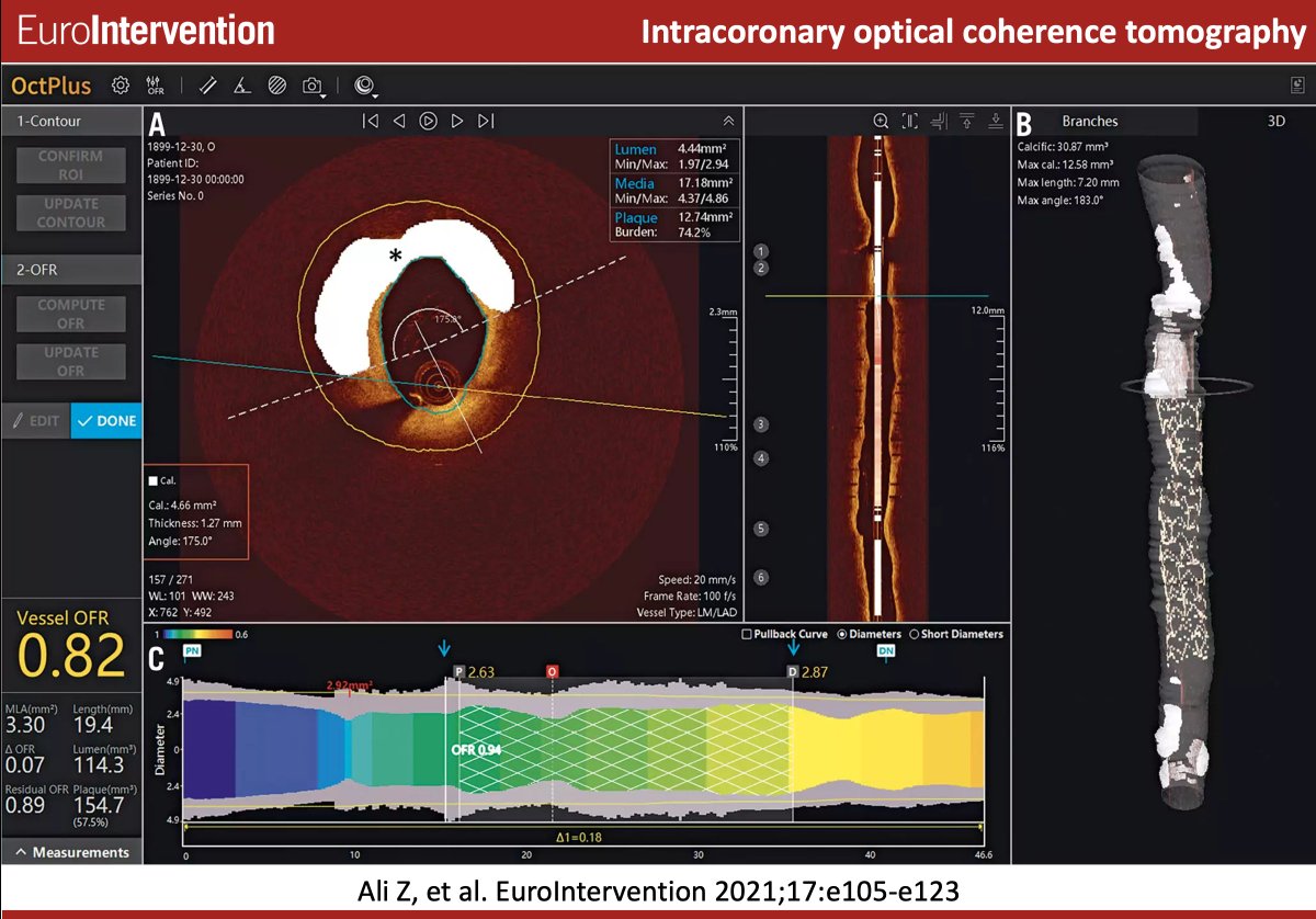 STATE OF THE ART #EIJBestOf: A comprehensive overview on the utility of #OCT in coronary artery disease, including technical details, simplified OCT image interpretation and an algorithmic approach for using OCT in PCI guidance. #EAPCI ow.ly/A83c50JAYOH