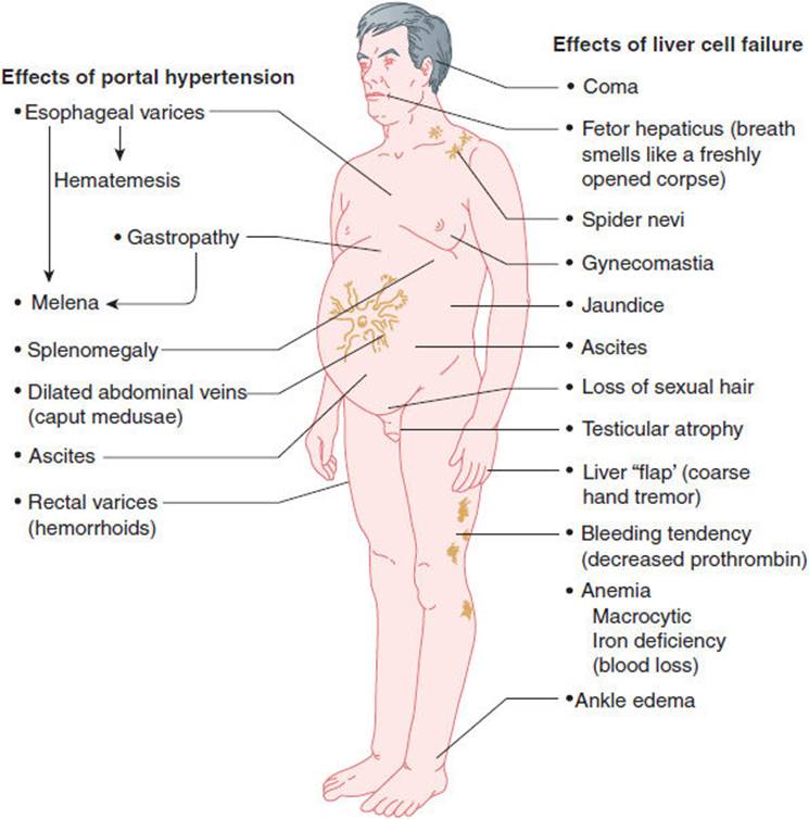 walinjom's tweet photo. Portal hypertension Vs Hepatocellular insufficiency. https://t.co/KcmYCDMtyZ