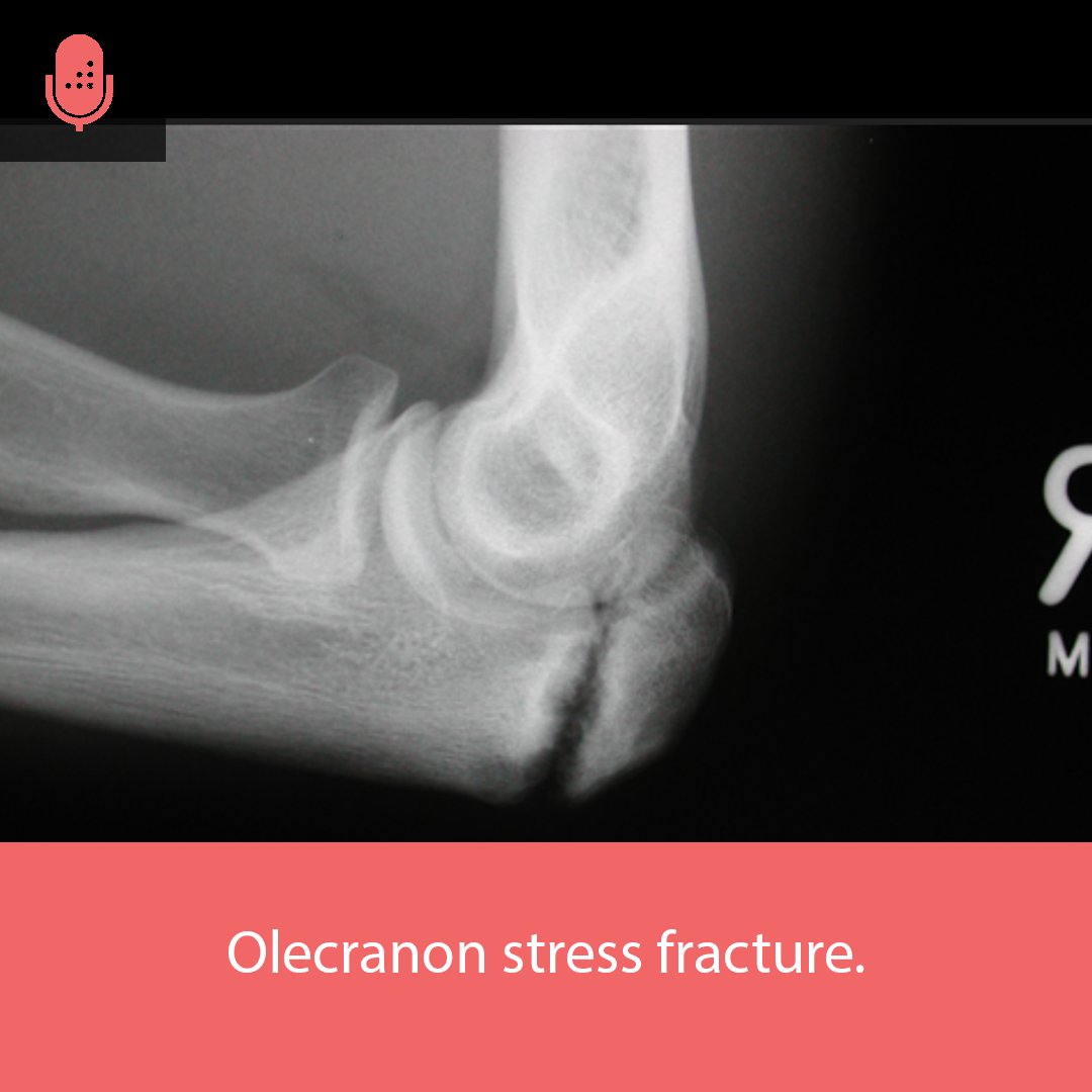 Fernando Meza on Twitter "RT orthobullets Olecranon Stress Fractures are rare elbow injuries