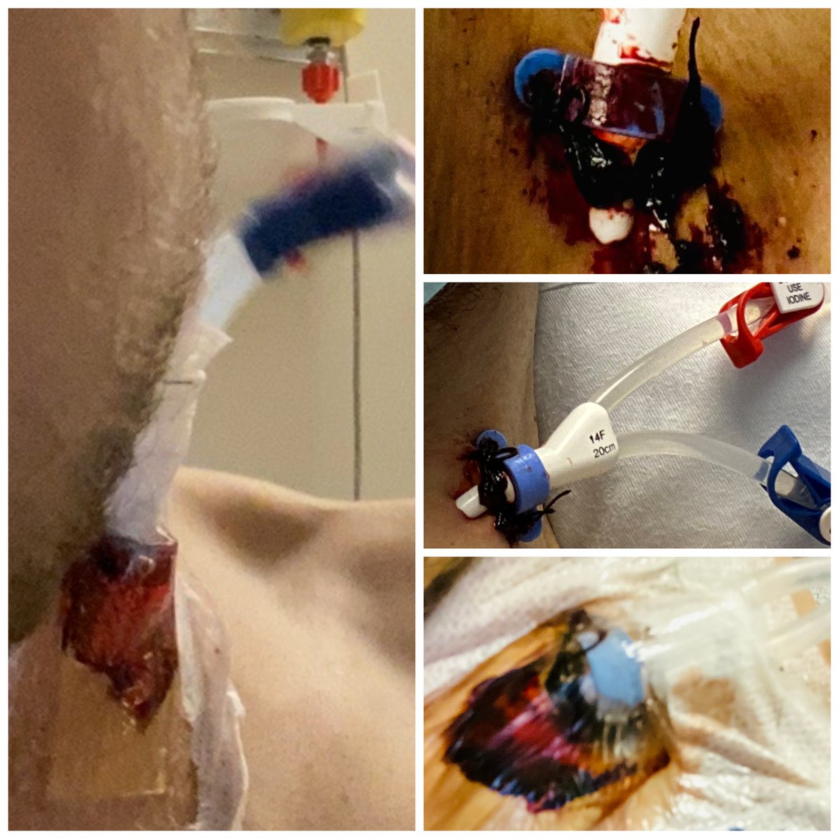 CainMonroe's tweet photo. 👀 how this neck catheter just keeps 🩸, not supposed to #bleed like that 🤔. Dr said gonna try to get a tunnel- more permanent- catheter for dialysis placed. 
🫤 throwing up a lot today. Appetite has been so good too 😔. Finally back up to 53 kilos (that’s 116.6 pounds). https://t.co/lSbC93rZpi