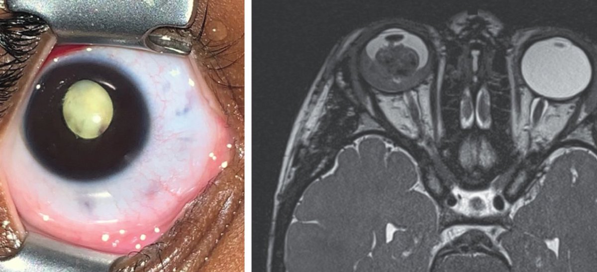 Studying Medicine on Twitter "Retinoblastoma rare eye retina cancer