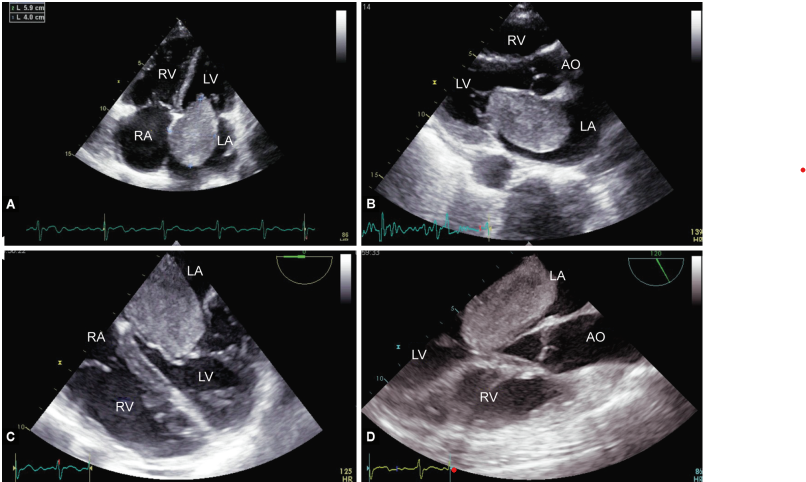 JaypeeBrother's tweet photo. Left Atrial Myxoma Causing Mitral Valve Obstruction
with Right Ventricular Dysfunction Complicated by Atrial
Fibrillation https://t.co/aIz2CPBFqd #Atrialfibrillation #Leftatriummyxoma #Rightventriculardysfunction #KamalKajal #KrishnaPGourav #GoverdhanDuttPuri #JaypeeJournals https://t.co/jcgnxlkV04