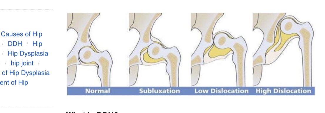 orthokcsh's tweet photo. The hip socket is shallow, allowing the head to slip in and out, moving partly or completely out of the socket. https://t.co/XDDW2deKD5