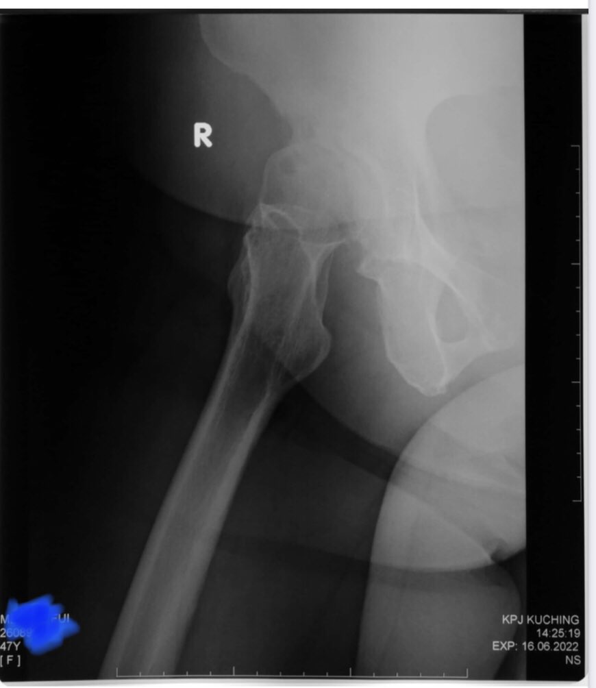 orthokcsh's tweet photo. Look at the right hip of this 56 yo lady with DDH as compared with the left. Right total hip replacement was done for moderate right hip pain, radiating to the groin and anterior thigh on weight bearing for 3 years . https://t.co/nTPXaJFkOh