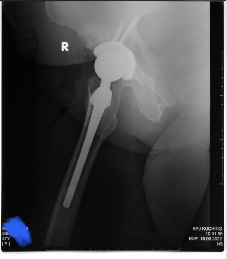 orthokcsh's tweet photo. Look at the right hip of this 56 yo lady with DDH as compared with the left. Right total hip replacement was done for moderate right hip pain, radiating to the groin and anterior thigh on weight bearing for 3 years . https://t.co/nTPXaJFkOh