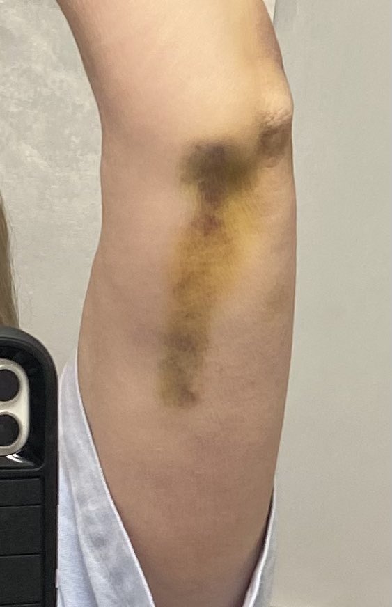 Suggestions4YOU's tweet photo. @architectlink @Walmart @WalmartInc Princeton location - been a week- still in pain -did you fix?  #slipfall https://t.co/Y69JtS8Ayi