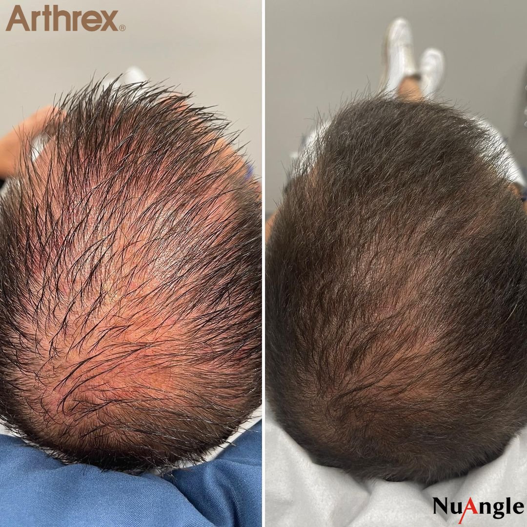 The power of PRP 🙌🏼
Book your treatment now! 
Credit: @ehlersdocs
#prp #arthrexprp #prphair