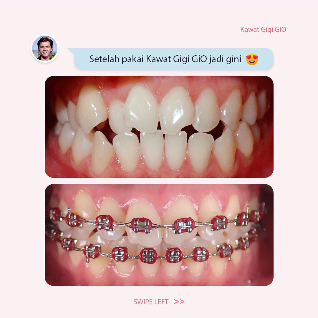 GiODentalCare's tweet photo. Gigi berubah jadi Rapi dan Sehat, bikin senyum makin sumringah ya Sayang GiO🥰
Kawat Gigi GiO solusinya
✨Ditangani Team Dokter dengan budaya JITU
✨Pilihan jenis Kawat Gigi lengkap
✨Perawatan Optimal &amp; terencana
✨Biaya terjangkau

Cus ke GiO sekarang🥰
#giokawatgigi #SayangGiO https://t.co/a6lgtA71qj