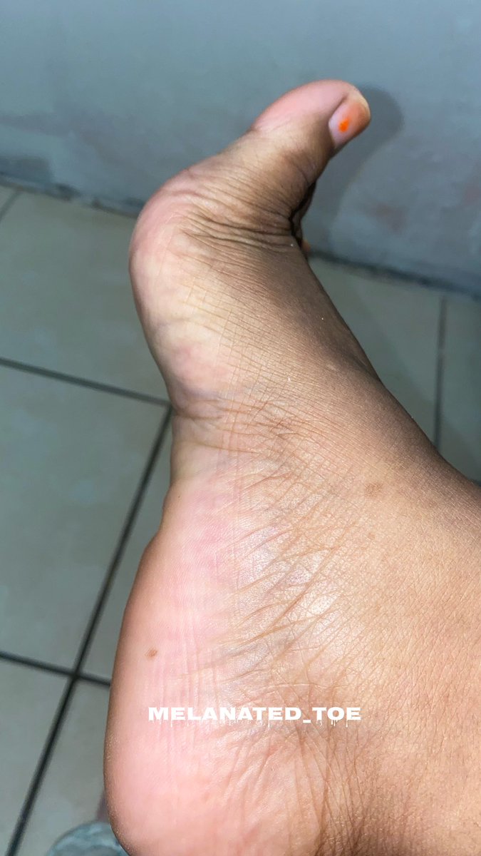 MelanatedToe's tweet photo. Foot😍 #feetpics #footfetısh #ebonyfeet #feetworship #feetfinder #feet https://t.co/97mpnE71sI
