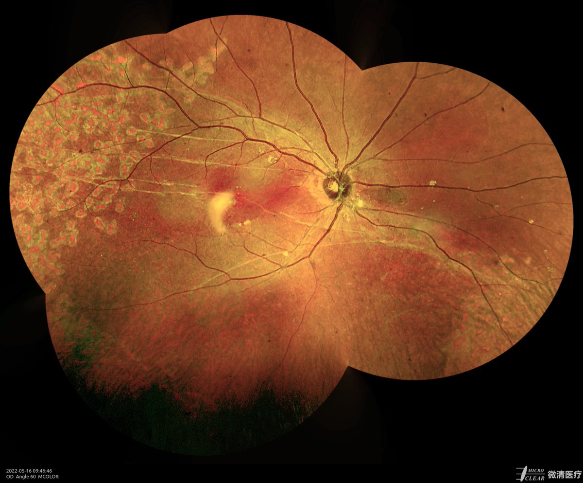 Post &amp; after surgery #retinaldetachment
Pictured by Apollo the #confocalretinalophthalmoscope
#retinopathy #angiography #autofluorescence #icga #fluoresceinangiography #funduscamera #ophthalmology #ophthalmic
