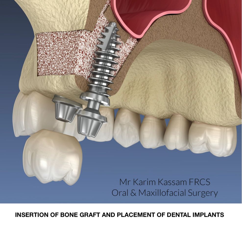 Maxillary #sinuses are behind the cheek above the roots of the upper back teeth. When teeth are lost the sinus descends down. The bone height in the area becomes less due to loss of teeth and sinus lining descent. 

#mrkarimkassamfrcs #leicester #london #plasticsurgery