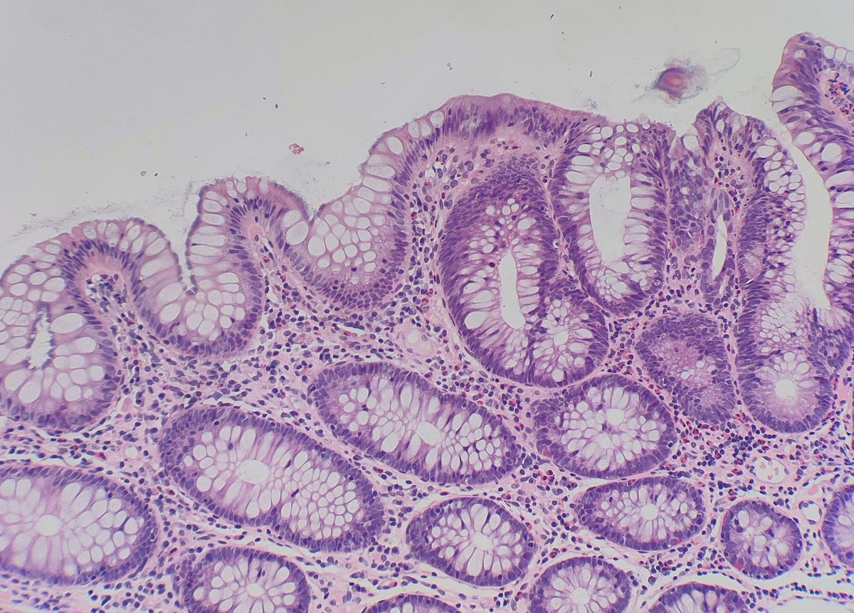 DraEosina's tweet photo. One of the nicest twofers one can find! Waiting for me to cheer up my Monday 🥰
Tubular adenoma with spirochetosis.
I no longer order any stains to confirm. Furry pattern is characteristic!
#GiPath #Pathology https://t.co/zYXhKpepKh