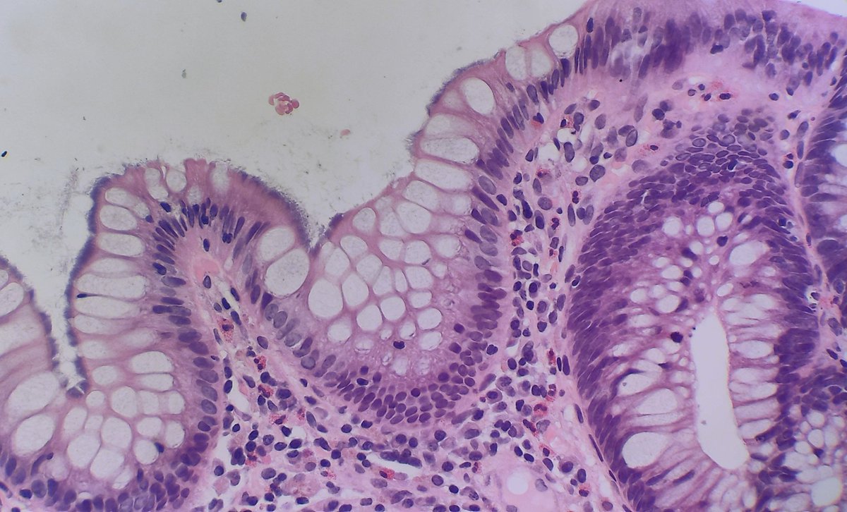 DraEosina's tweet photo. One of the nicest twofers one can find! Waiting for me to cheer up my Monday 🥰
Tubular adenoma with spirochetosis.
I no longer order any stains to confirm. Furry pattern is characteristic!
#GiPath #Pathology https://t.co/zYXhKpepKh