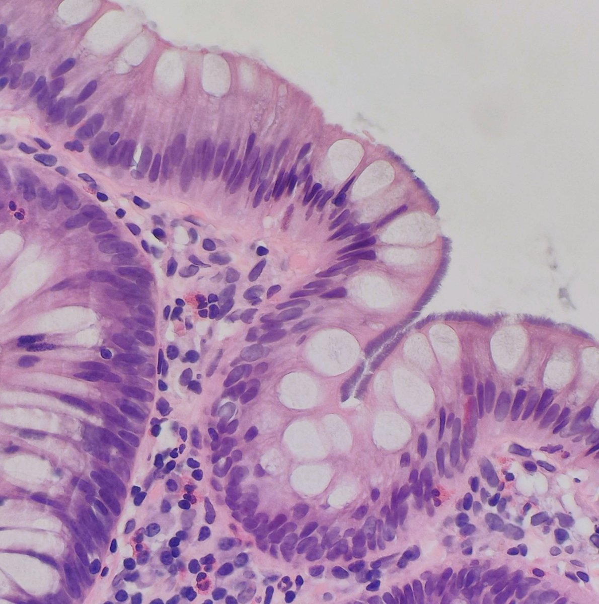 One of the nicest twofers one can find! Waiting for me to cheer up my Monday 🥰
Tubular adenoma with spirochetosis.
I no longer order any stains to confirm. Furry pattern is characteristic!
#GiPath #Pathology