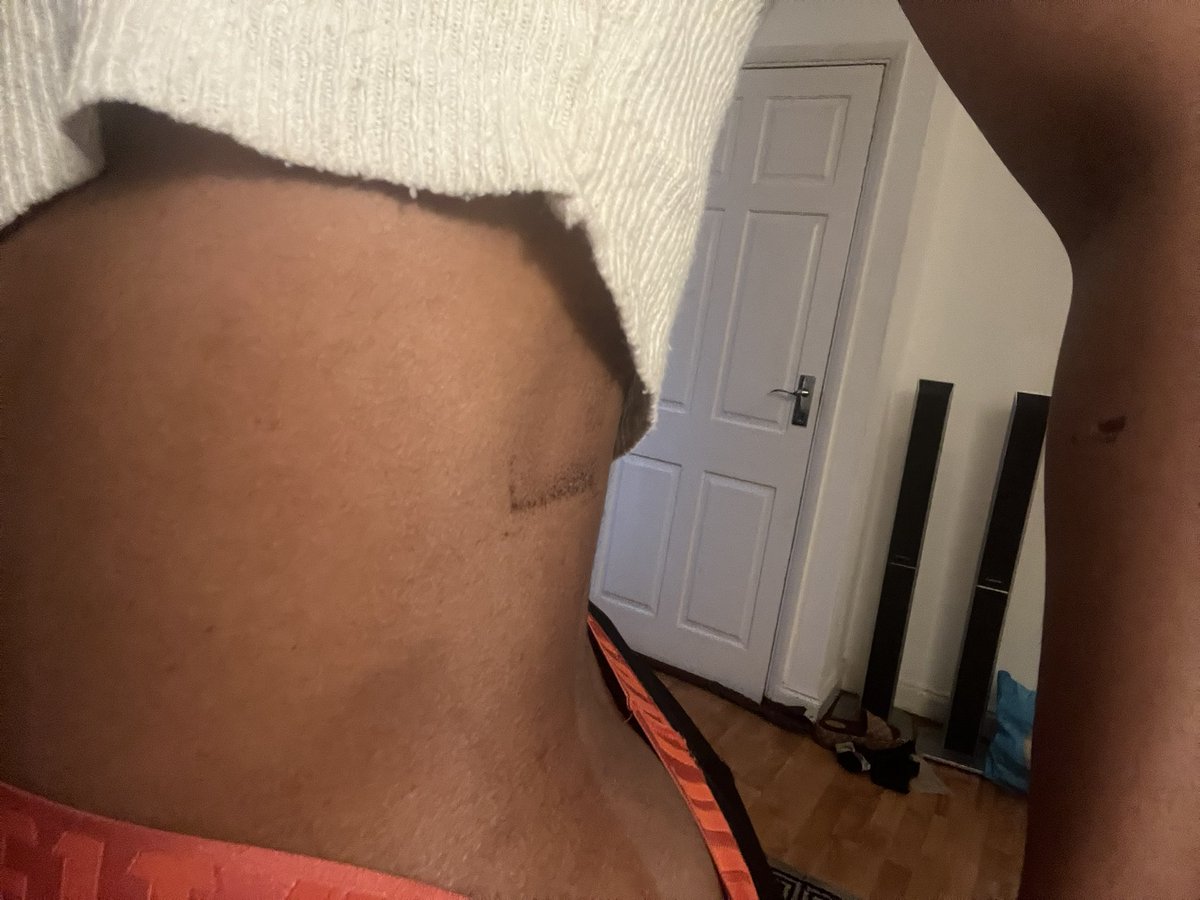 BriellaNeme's tweet photo. @okah_dorcas @DavidHundeyin @burnaboy You want proof! These are just two bruises on my body, my partners head after he got stitches and the gunshot wound to his friends thighs. https://t.co/7Vc2BhCxDk