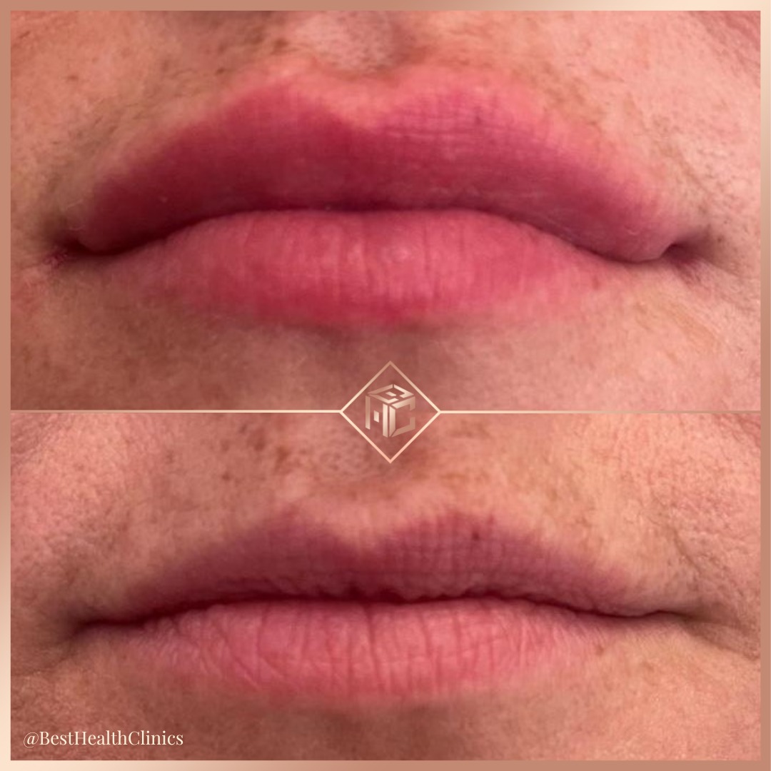 ✨ before and after lip fillers✨

👄 - Amazing results from Dr May Gilbert, using 1ml of lip fillers Restylane Kysse.

To get booked in for your appointment -
📞call us - 01708 477 577
📧 email us - info@bhclincs.com
📥 dm us to get booked in!