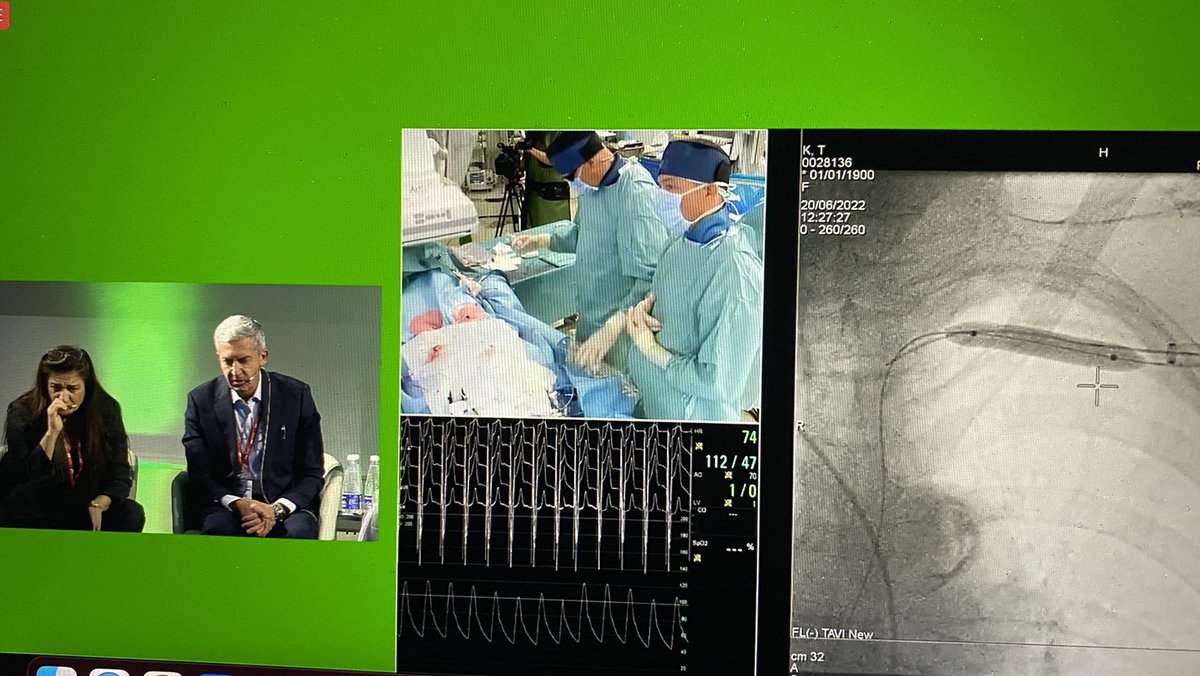 sabeedak1's tweet photo. Great #tavr case #axillary #bicuspid @drnvanmieghem #largeboreclosure #JIM2022 https://t.co/CLHjrRjqw6