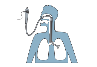🤔¿Qué es la #broncoscopia? 

👆Es una prueba que permite examinar el interior de las vías respiratorias (tráquea y bronquios) mediante la introducción de un tubo flexible (broncoscopio) de pequeño calibre a través de la nariz o de la boca.

#SEPARrespira #SEPARpacientes