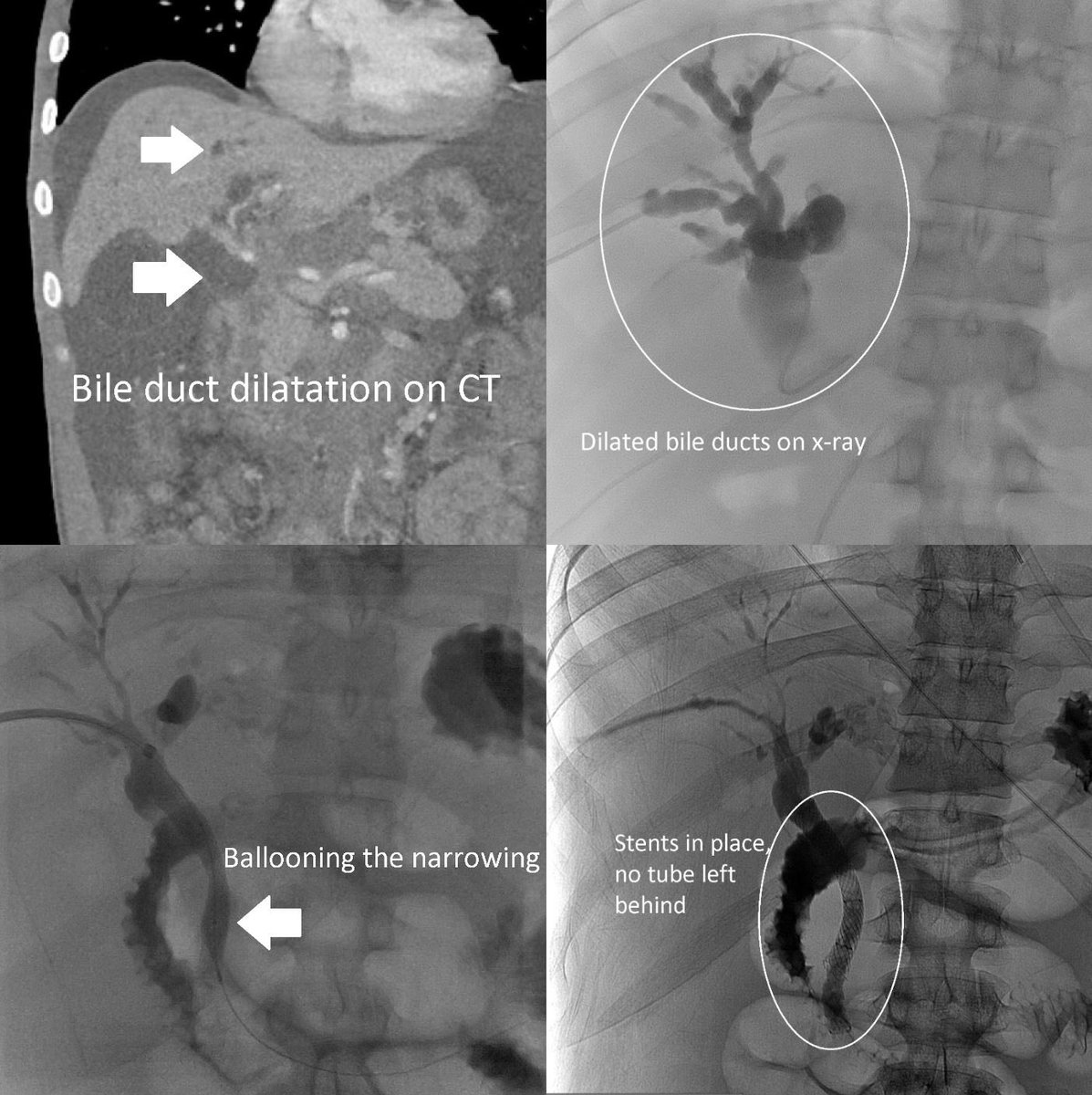 Patient with #PancreaticCancer obstructing the bile ducts with failed #endoscopy stent placement. Interventional radiology (#IRad) is able to access the ducts using ultrasound &amp; xray guidance, cross the obstruction with wires, and then place stents to relieve the obstruction.