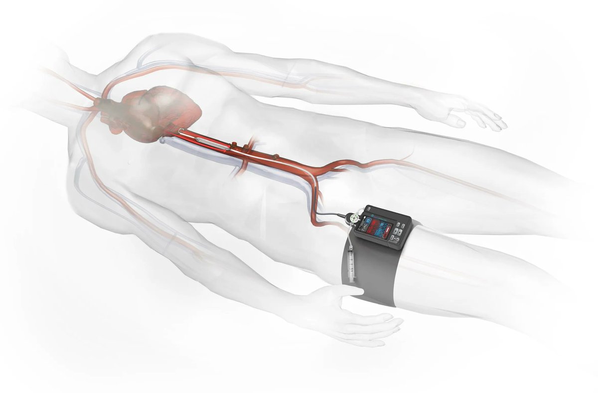 EVAC Fact No. 1️⃣// It’s a precise, adaptive #endovascular device that controls blood pressure &amp; flow to treat conditions such as hemorrhage, cardiac arrest, and stroke. Read about our flagship #medtech 👉buff.ly/3stILLC