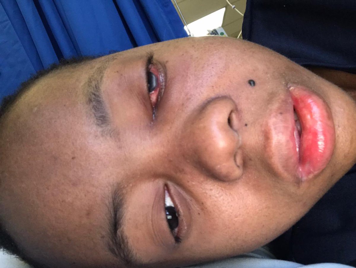 dubeziyanda's tweet photo. **Update**
This whole week has been really rough on my sister and on us as a family. Zanele is not responding to the treatment she is getting which we knew that hence why her Dr told us to move to this specific Dr as soon as possible but due to not being able to raise enough https://t.co/v7ARBL8d8S