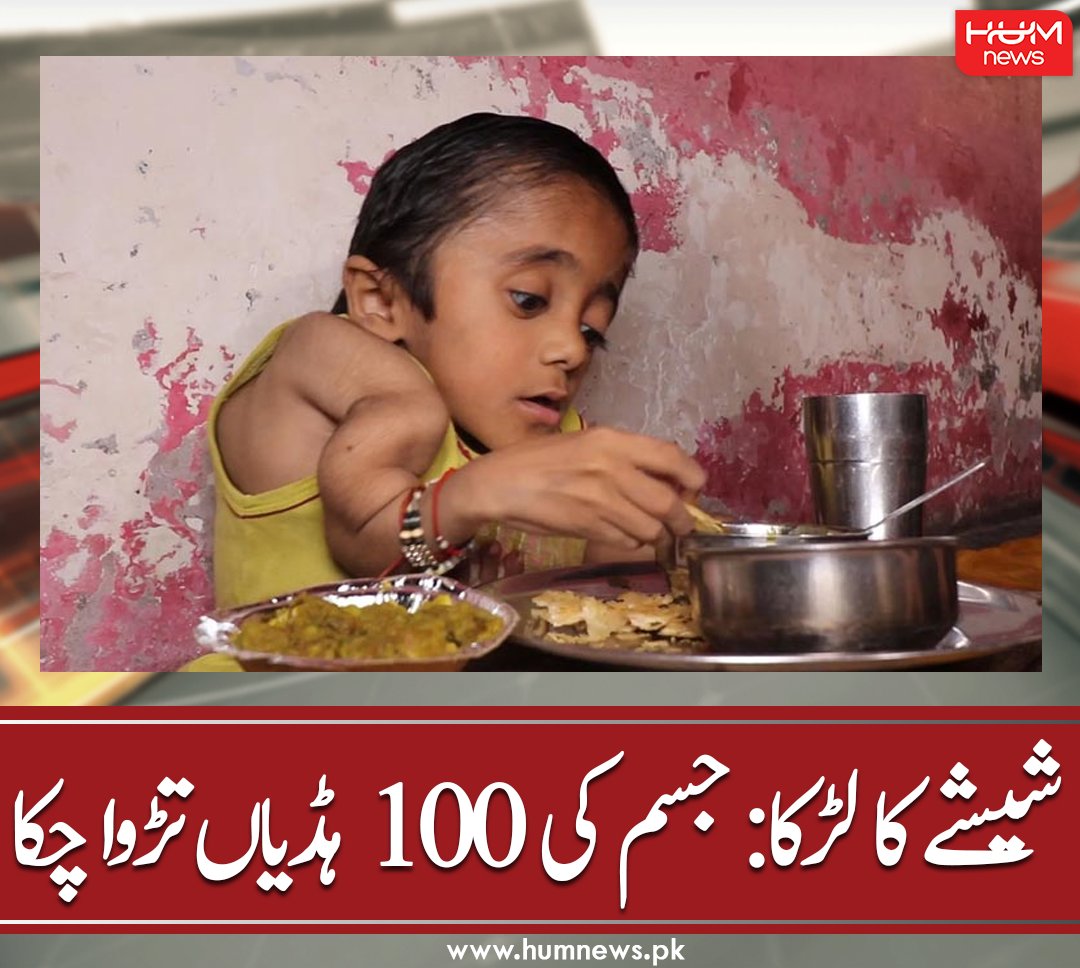 humnewspakistan's tweet photo. شیشے کا لڑکا: جسم کی 100 ہڈیاں تڑوا چکا
مزید پڑھیں: https://t.co/0kKaPydAgh
#HumNews #IndianBoy #Rohit #MadeOfGlass #BonesBreak #SlightestTouch #BrittleBoneDisease # https://t.co/E06DDY2RiZ