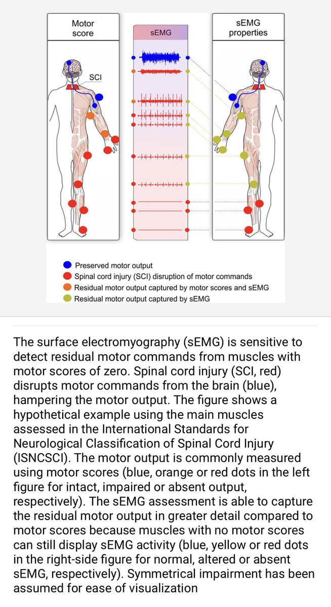 SekcjaNeuro's tweet photo. Great graphic from latest article of Gustavo Balbinot showing the difference in assessing patient after SCI with subjective scale or when adding surface EMG to evaluation
👇👇👇 https://t.co/MaMIsc1DAL