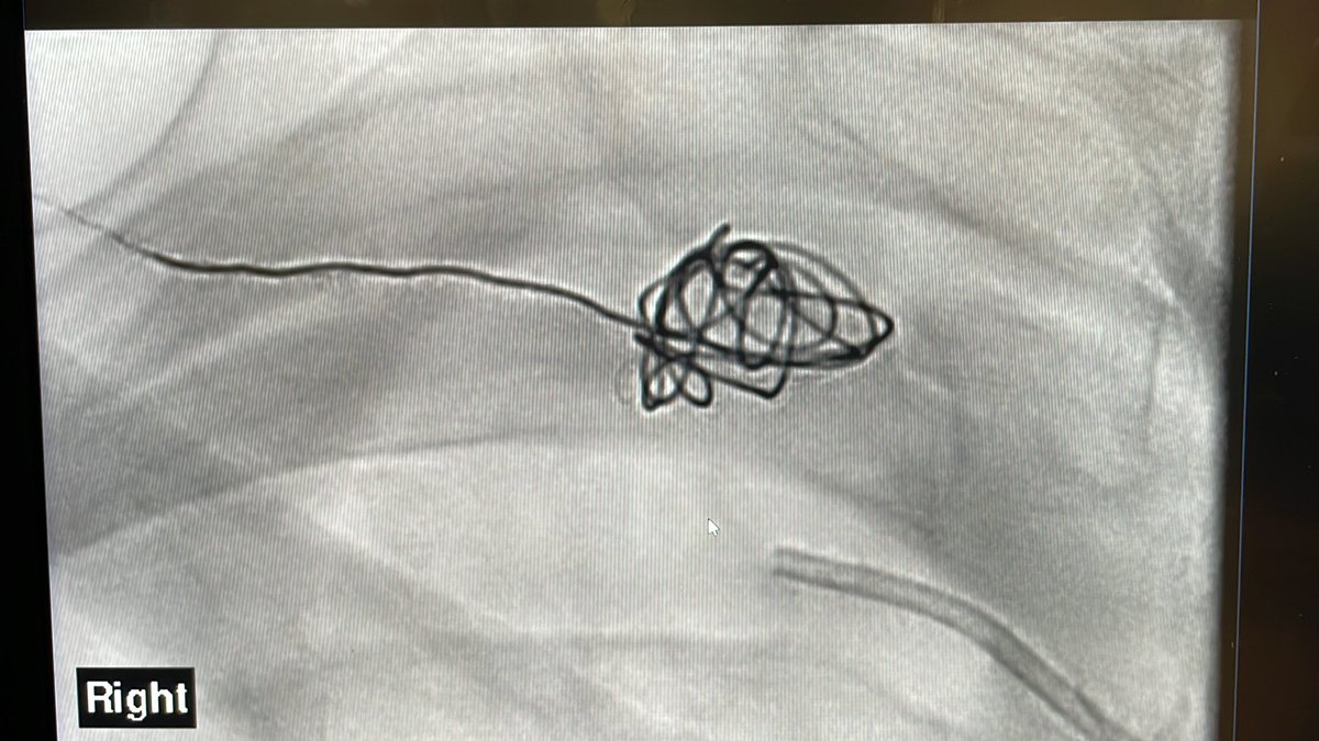 From <a href="/EmoryIRad/">Emory University Interventional Radiology</a> archives 
Percutaneous coiling of subclavian PSA/ 2/2 iatrogenic injury