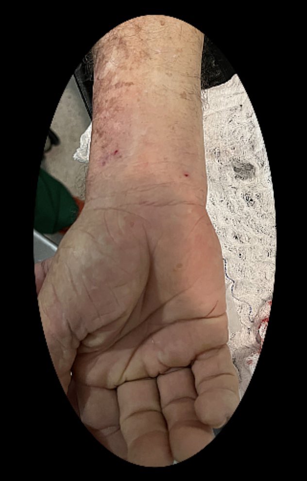 evandrofilhobr's tweet photo. Be gentle with your forearm access so they will forgive you 😉.
Accessory radial, impossible crossover.
Ipsilateral ulnar to bailout and allow complete cor angiogram.
Hand compression for hemostasis & final US doppler
#radialfirst #ulnarsecond https://t.co/WZc1DVYd7R