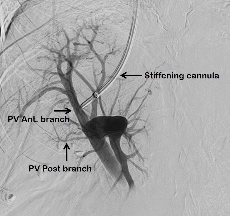 SRajesh_IR's tweet image. Late night call for rescue TIPS

77y/F with right posterior segmental infiltrative HCC attenuating the adjoining portal venous branch.

Stiffening cannula modified on table to exaggerate the curve and right anterior portal vein branch accessed under USG guidance.