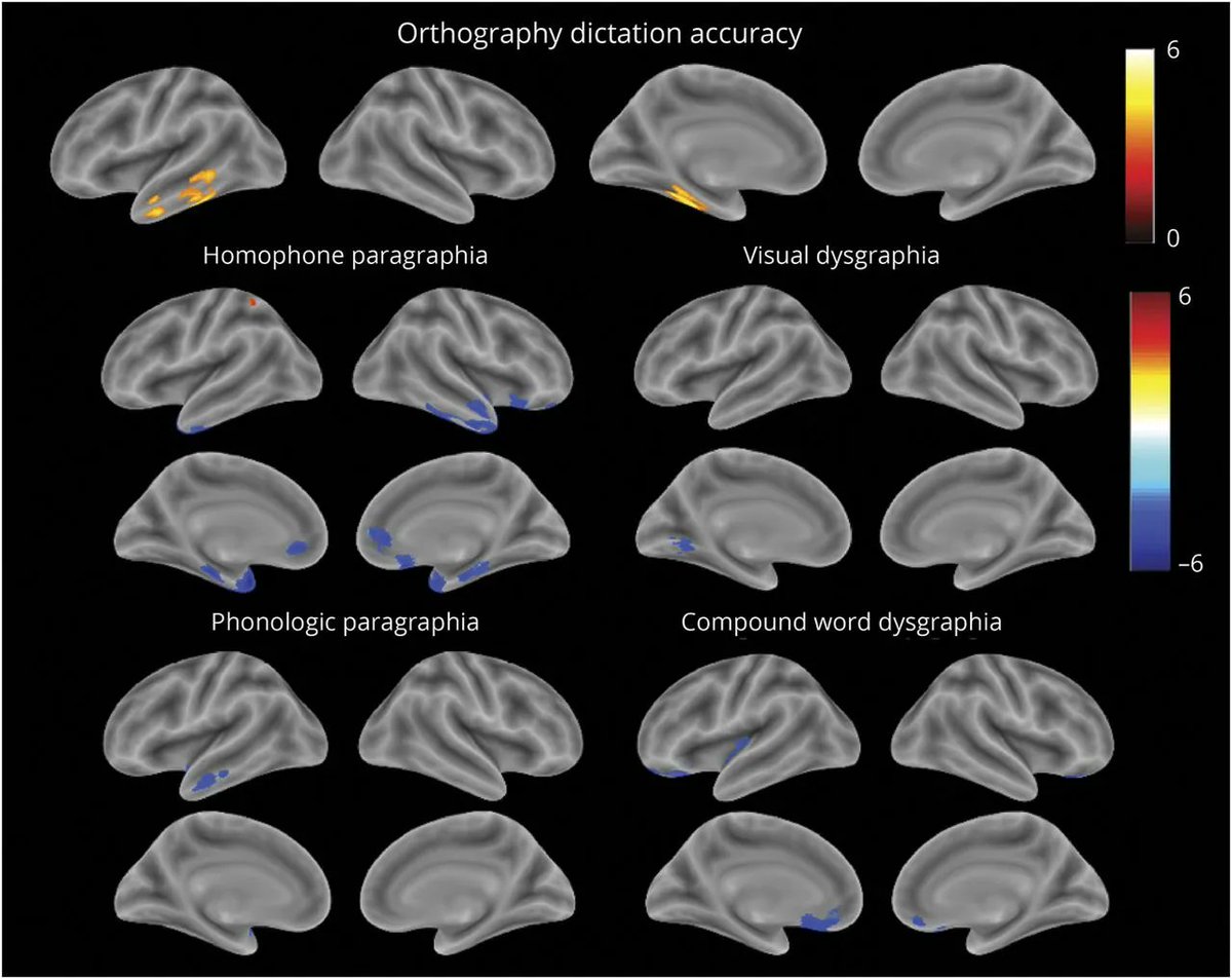 UCSF MAC (@ucsfmac) on Twitter photo Dysgraphia Phenotypes in Native Chinese Speakers With Primary Progressive Aphasia. Diagnostic utility of dysgraphia phenotypes in classifying PPA variants. bit.ly/3QrQFzw
<a href="/LeadTee/">Boon Lead Tee</a> <a href="/GvnBattistella/">Giovanni Battistella</a> @DataCooker <a href="/brucemillerucsf/">Bruce Miller</a> <a href="/AlbaLanguage/">ALBA Language Neurobiology laboratory</a> Dysgraphia Phenotypes in Native Chinese Speakers With Primary Progressive Aphasia. Diagnostic utility of dysgraphia phenotypes in classifying PPA variants. bit.ly/3QrQFzw
<a href="/LeadTee/">Boon Lead Tee</a> <a href="/GvnBattistella/">Giovanni Battistella</a> @DataCooker <a href="/brucemillerucsf/">Bruce Miller</a> <a href="/AlbaLanguage/">ALBA Language Neurobiology laboratory</a>