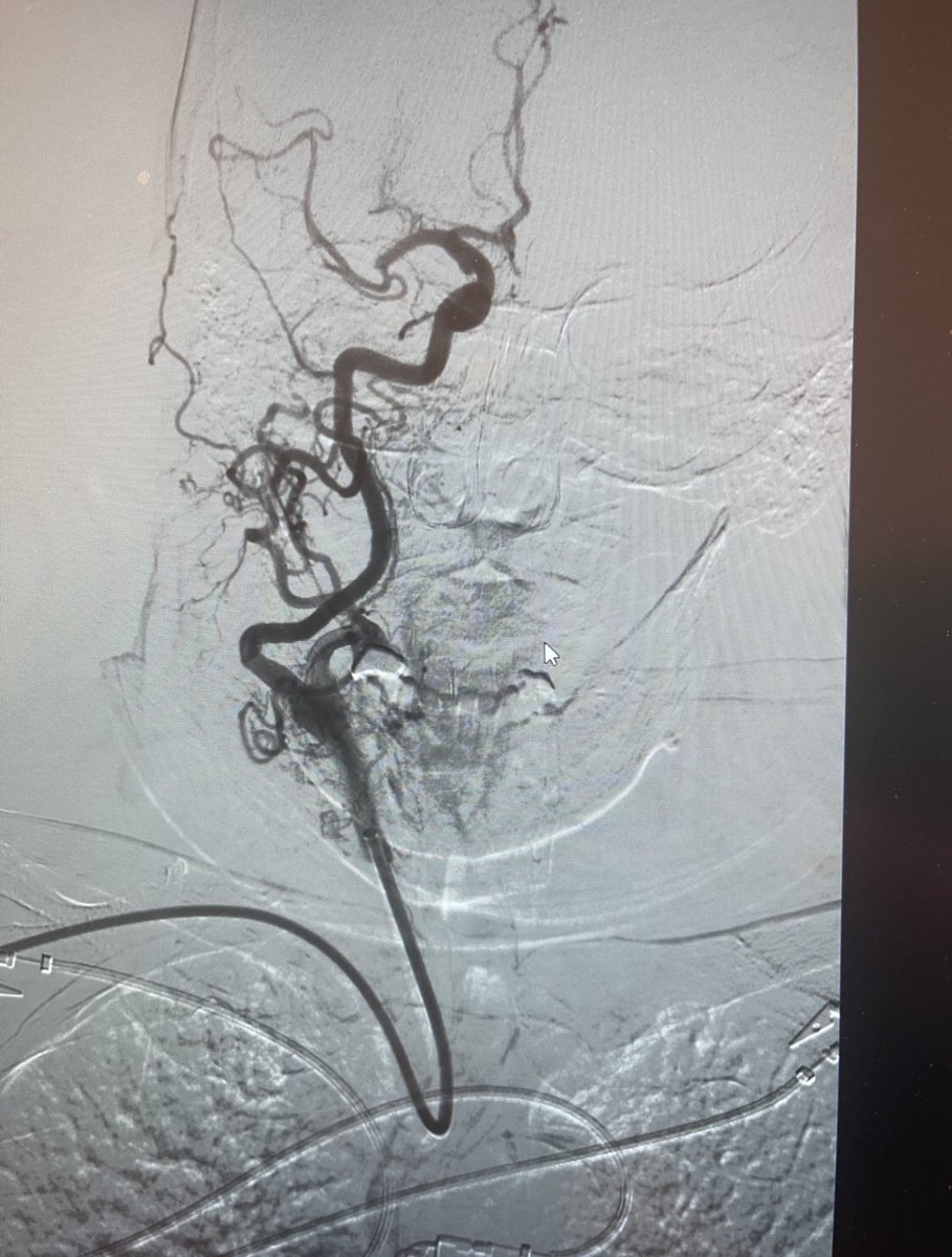 EinsteinIR's tweet photo. Acute MCA occlusion. Type 3 aortic arch. Sometimes it takes an arm and a leg to get the job done. #itsallinthewrist #radialaccess #thrombectomy @dmbiederman @SIRRFS https://t.co/QgZr4Ja5iC
