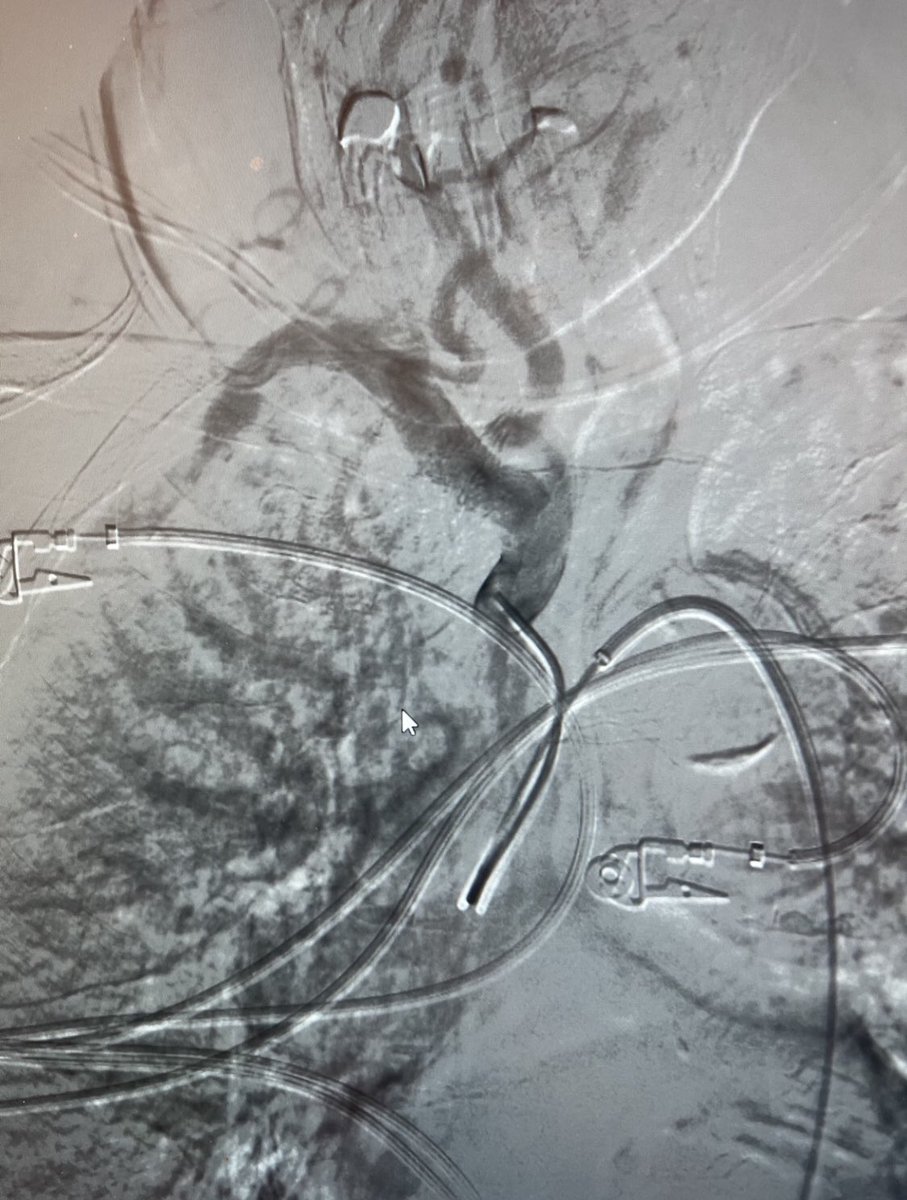 EinsteinIR's tweet photo. Acute MCA occlusion. Type 3 aortic arch. Sometimes it takes an arm and a leg to get the job done. #itsallinthewrist #radialaccess #thrombectomy @dmbiederman @SIRRFS https://t.co/QgZr4Ja5iC
