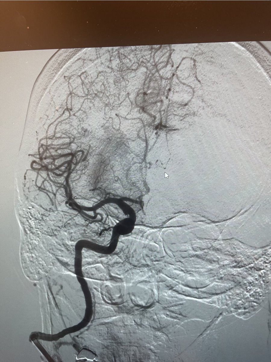 Acute MCA occlusion. Type 3 aortic arch. Sometimes it takes an arm and a leg to get the job done. #itsallinthewrist #radialaccess #thrombectomy <a href="/dmbiederman/">Derek Biederman</a> <a href="/SIRRFS/">SIR RFS</a>