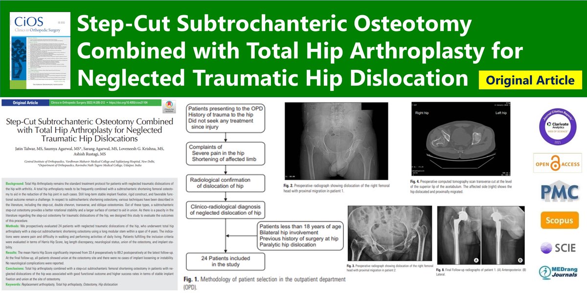 CiOSjournal's tweet photo. Step-Cut Subtrochanteric Osteotomy Combined with Total Hip Arthroplasty for Neglected Traumatic Hip Dislocations
open access🌷https://t.co/Sr1HqiRYs2
2022 Jun;14(2) Jatin Talwar
#Replacement_arthroplasty #Total_hip_arthoplasty 
#Osteotomy #Hip_dislocation https://t.co/VPkZpA1szM