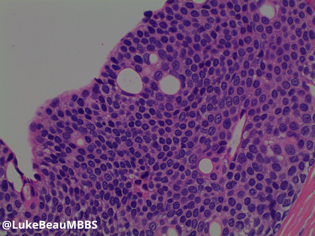 LukeBeauMBBS's tweet photo. First post, interesting case. Knee cyst in a young adult. 
#pathology #pathtwitter #dermpath
Answer: https://t.co/5EzB4pKog2
(Shoutout to @TristanRutland7 and @JMGardnerMD who inspired me to start posting) https://t.co/hET650eYIu