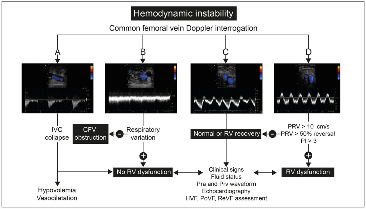 Phenotypes of Femoral vein #Doppler waveform in the context of hemodynamic assessment.
Pra = right atrial pressure
Prv = RV pressure
PoVF = portal venous flow
ReVF = renal venous flow
PRV = peak retrograde velocity
🔗ncbi.nlm.nih.gov/pmc/articles/P…
#POCUS #VExUS #MedEd #Nephrology