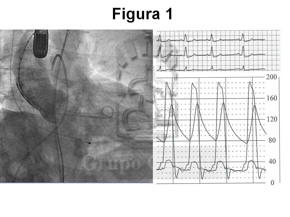grupocorpal's tweet photo. Implante de prótesis CoreValve a paciente con estenosis aórtica severa #corevalve #cardiologia #cateterismo #casoclinico
👉https://t.co/XPhh2iAvjw https://t.co/1hLkGhE5t0