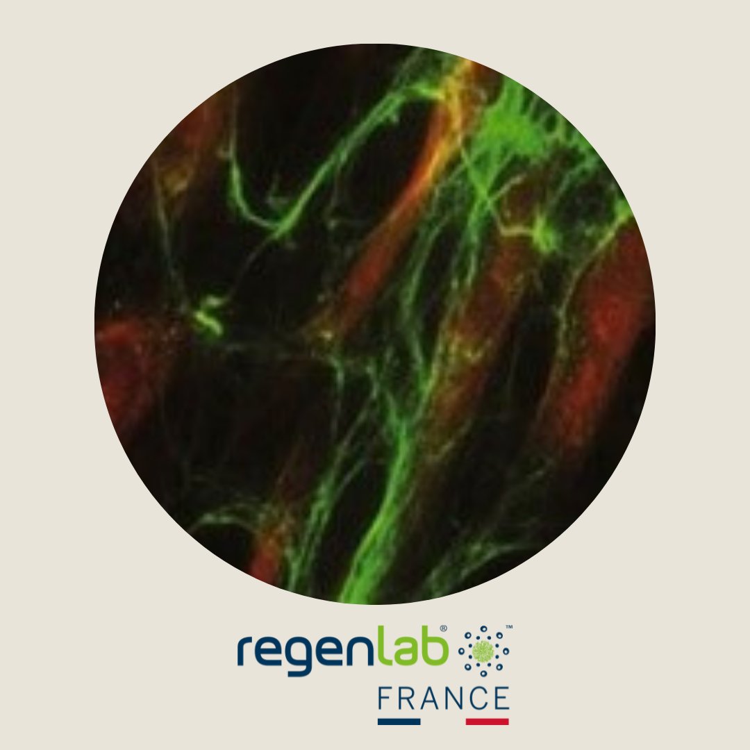 RegenlabFR's tweet photo. [Dematologie] Les traitements de PRP agissent sur l'activité métabolique des fibroblastes in vitro.
Plus de détails ici :
👉https://t.co/ExKcCcgfVr
#PRP #MedecineRegenerative #Vergetures #Cicatrices https://t.co/R07a08PXer