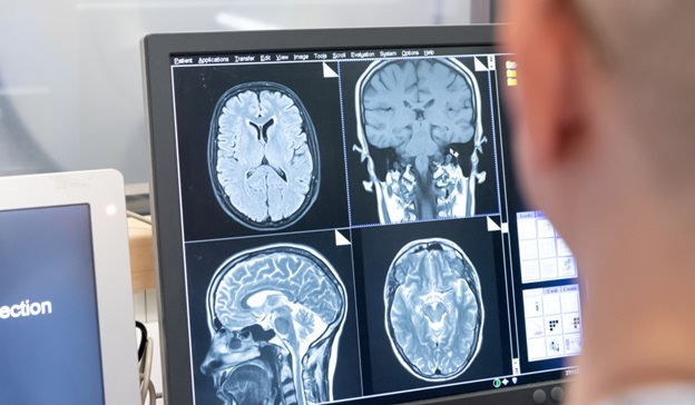 ImperialNHS's tweet photo. A single MRI scan of the brain could be enough to diagnose #Alzheimers, according to a new study led by @imperialcollege and clinicians from the Trust.

Full story ➡️ https://t.co/LhZQ9IgQ5x https://t.co/DcE5VEjySq