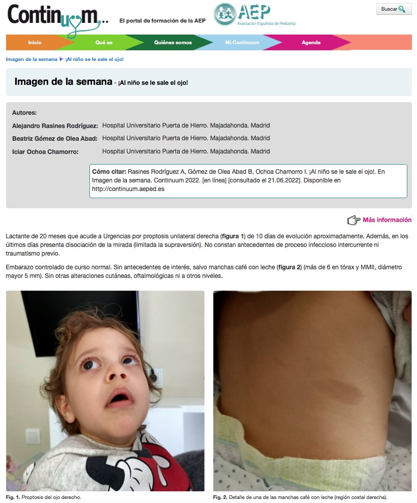 ContinuumAEP's tweet photo. #ImagendelaSemanaAEP: ¡Al ni­ño se le sa­le el ojo! https://t.co/zG5TZu3F4a ¿Cuál es tu diagnóstico? https://t.co/iyFYZwWXQn