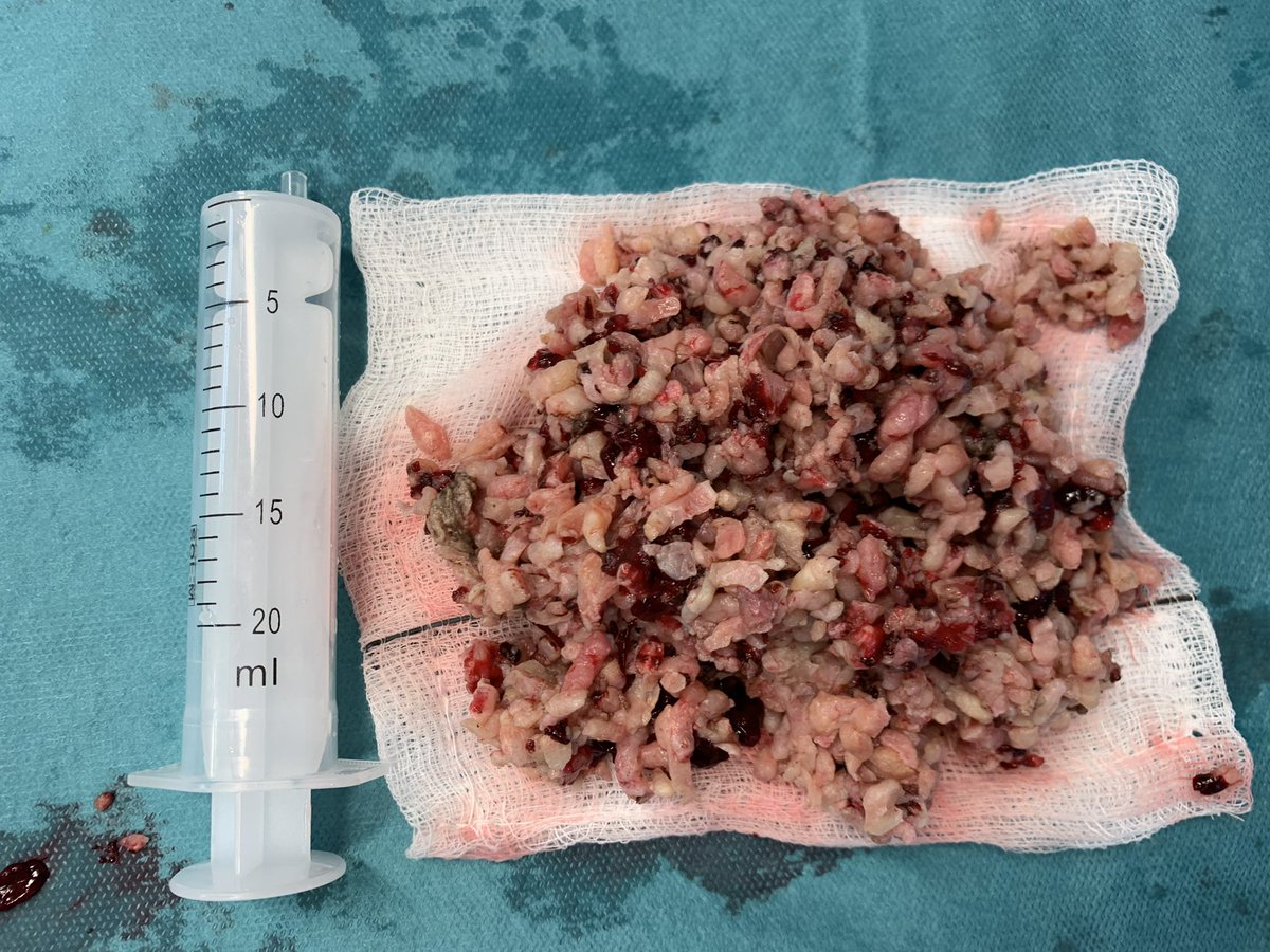 kpetik1's tweet photo. In this era of #HoLEP 1s has to be calm and keep on doing what they have in their hands and try to evolve to the next level&keep on waiting having a holmium machine!😂😂 #tryingmybest #aeep #tueb #bipolar #enucleation @ZoltanKissDr @GoumasUrologia @FCAFigueiredo @jackchelchowski https://t.co/VbZg3iGwq0
