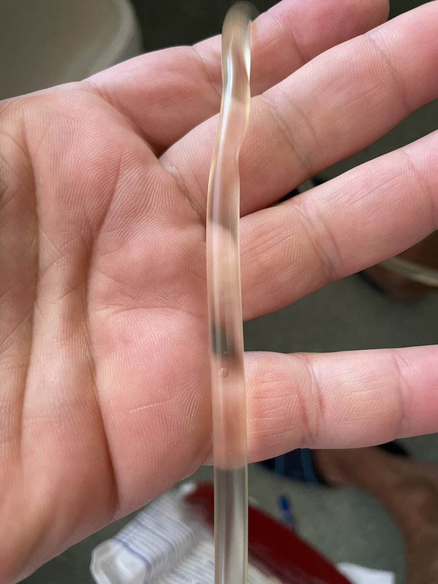 In this era of #HoLEP 1s has to be calm and keep on doing what they have in their hands and try to evolve to the next level&amp;keep on waiting having a holmium machine!😂😂 #tryingmybest #aeep #tueb #bipolar #enucleation <a href="/ZoltanKissDr/">Zoltán Kiss</a> @GoumasUrologia <a href="/FCAFigueiredo/">Felipe Figueiredo HoLEP 🇧🇷</a> <a href="/jackchelchowski/">Jacek Chełchowski</a>