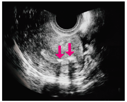 CEOGjournal's tweet photo. Separate transfer of two frozen-thawed embryos reduces multiple gestations in assisted reproductive technology
🔗https://t.co/Je9ahKCgdL
#ART #assisted_reproductive_technology #embryo_transfer #Obstetrics #Pregnancy #Embryos #Ultrasound https://t.co/W6JEgWQFxP