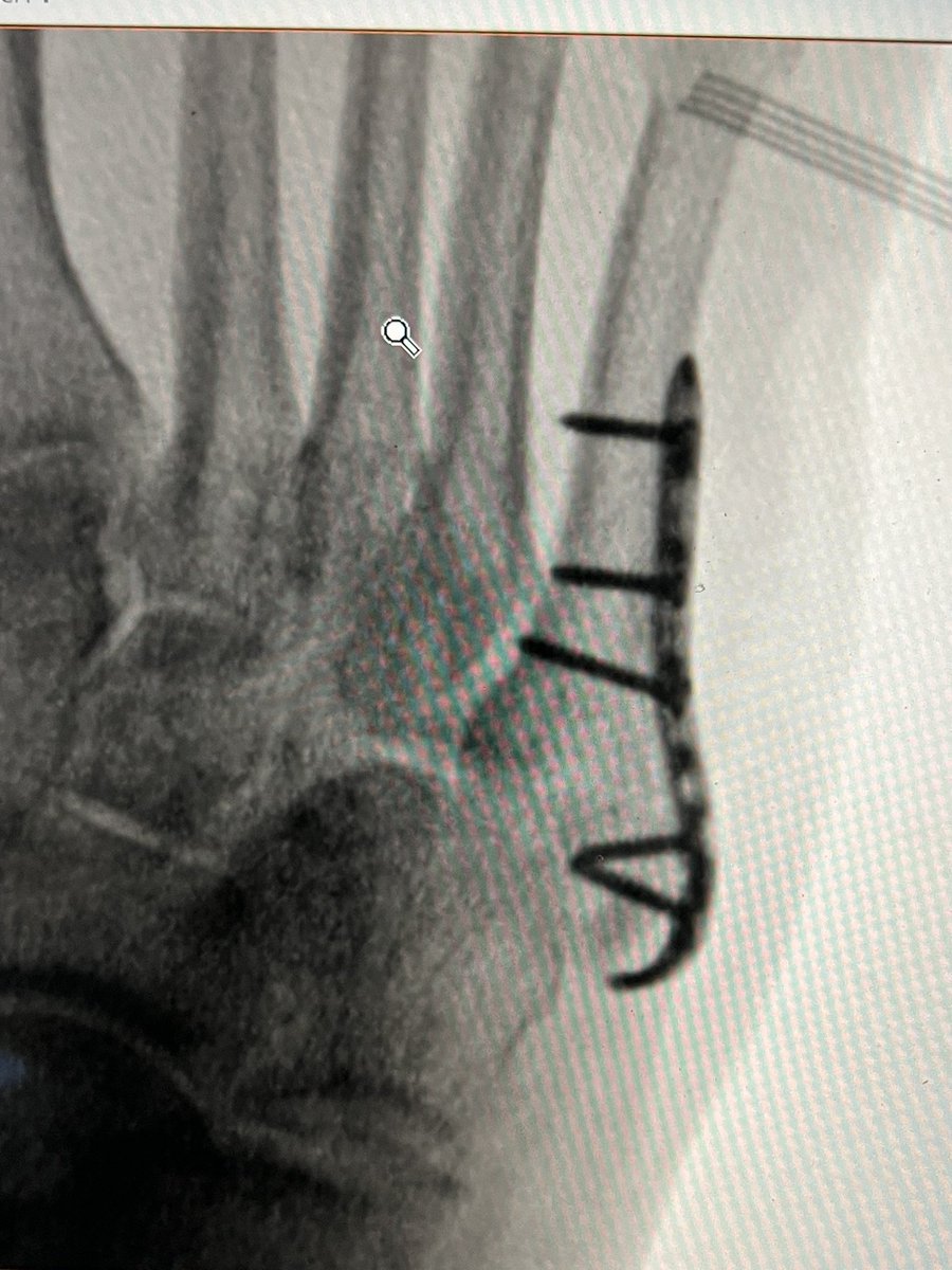 DrBhavinJadav's tweet photo. Some times an Ulna Hook Plate from the wrist set becomes more versatile. #OrthoTwitter https://t.co/5rZ7bAf7hR