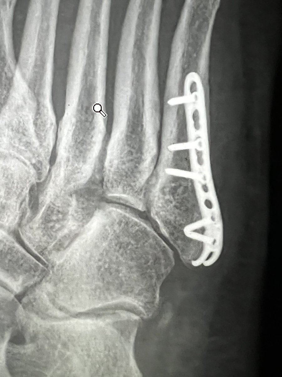 Some times an Ulna Hook Plate from the wrist set becomes more versatile. #OrthoTwitter