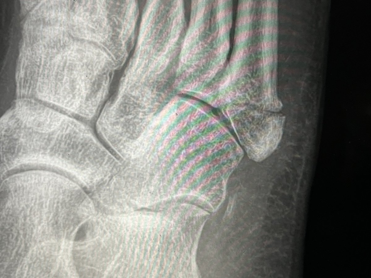 DrBhavinJadav's tweet photo. Some times an Ulna Hook Plate from the wrist set becomes more versatile. #OrthoTwitter https://t.co/5rZ7bAf7hR